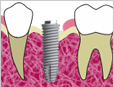 インプラントとは