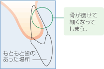 骨移植