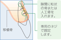 骨移植