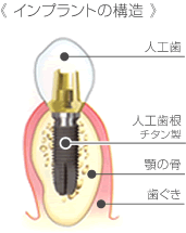 インプラント