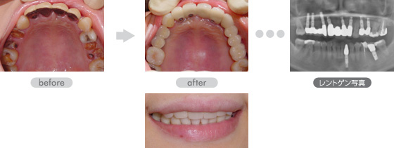インプラント治療例